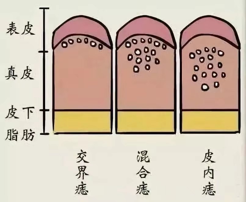痣千万不要随便点，除了影响美观还有很大的潜在危险！