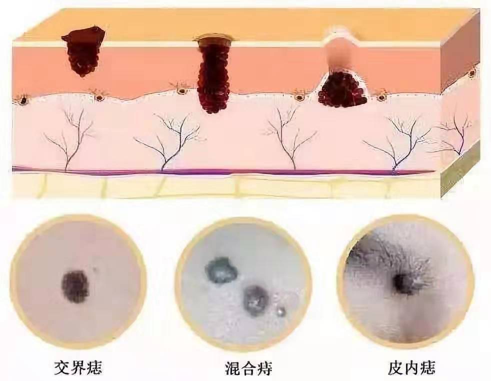 痣千万不要随便点，除了影响美观还有很大的潜在危险！