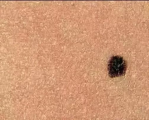 痣千万不要随便点，除了影响美观还有很大的潜在危险！