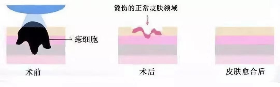 痣千万不要随便点，除了影响美观还有很大的潜在危险！