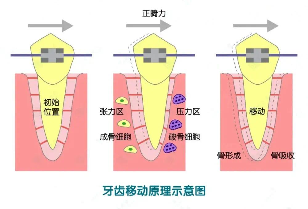 矫正结束了为什么还要戴保持器？
