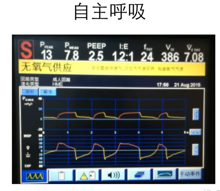 超实用临床干货---机械通气使用之呼吸机模式选择及参数设置（2）