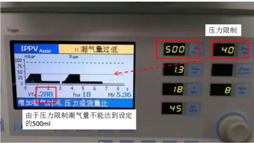 呼吸机 5 种模式不会选择？看完这篇你就懂了！