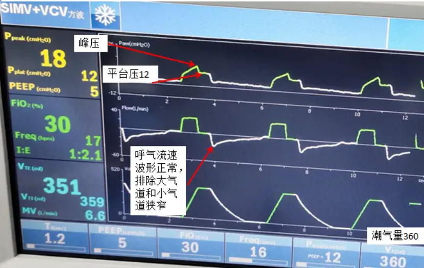 呼吸机 5 种模式不会选择？看完这篇你就懂了！