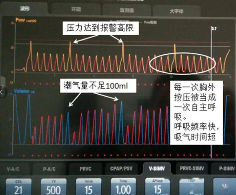 呼吸机 5 种模式不会选择？看完这篇你就懂了！