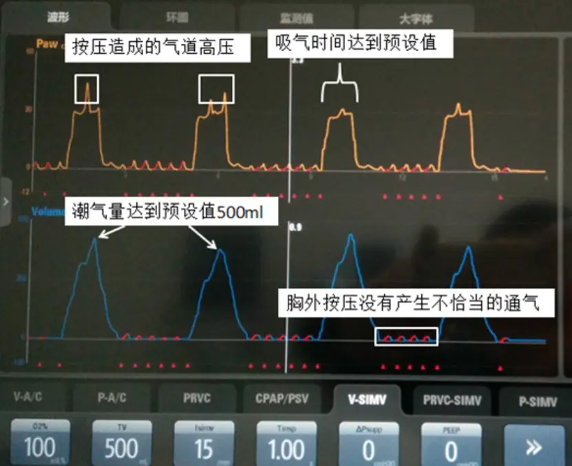 呼吸机 5 种模式不会选择？看完这篇你就懂了！