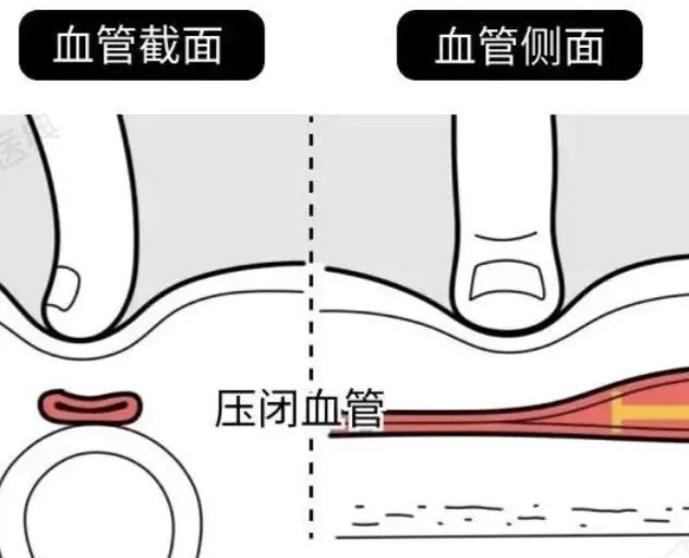同心医+｜外伤、出血如何应对？急救技术学起来