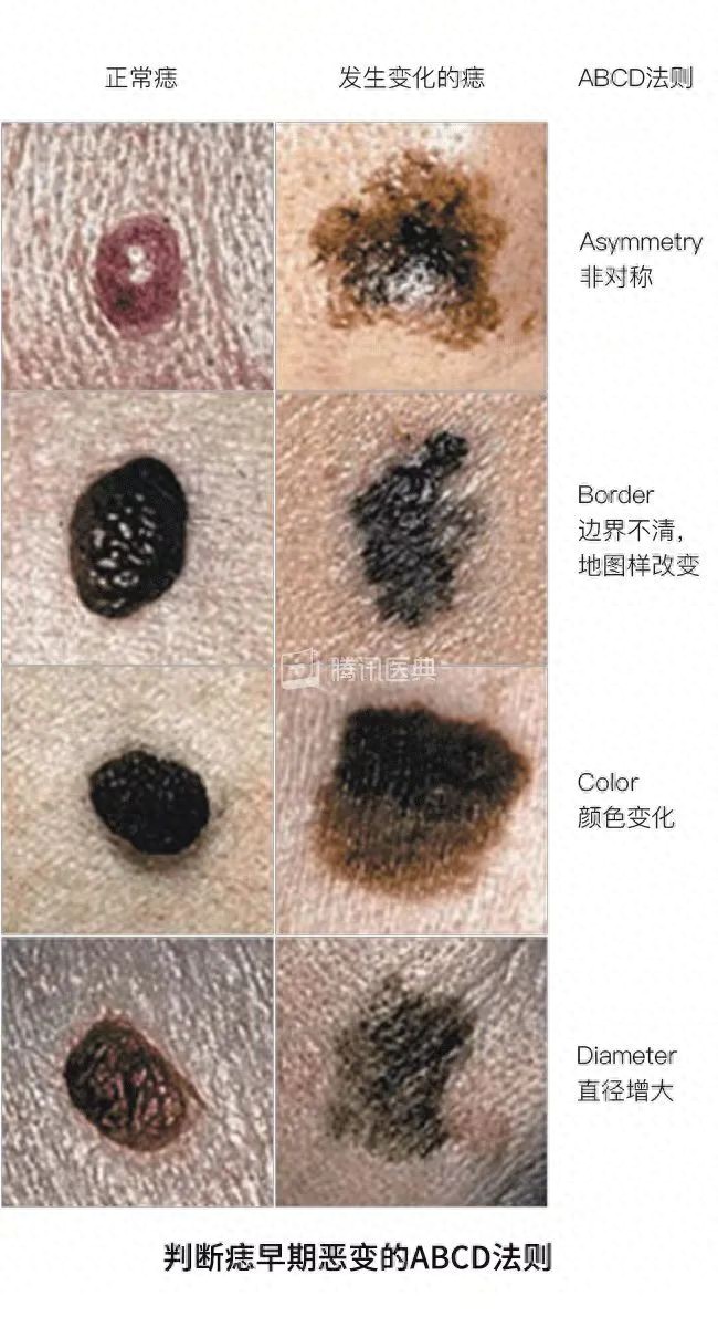 “医生，我这颗痣要不要点？”