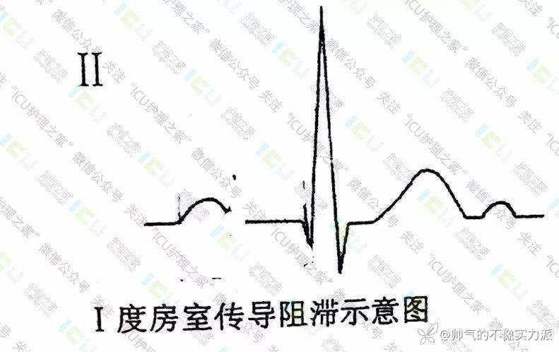 手把手教你看心电图，婴儿式教学