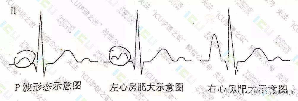 手把手教你看心电图，婴儿式教学