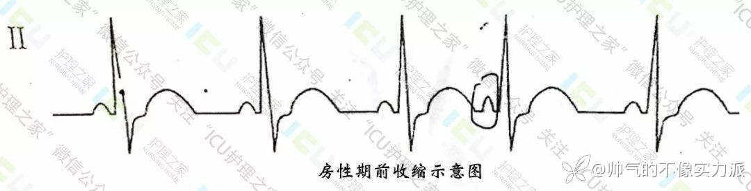 手把手教你看心电图，婴儿式教学