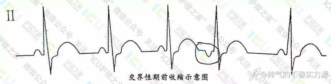手把手教你看心电图，婴儿式教学
