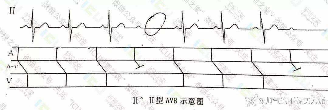 手把手教你看心电图，婴儿式教学