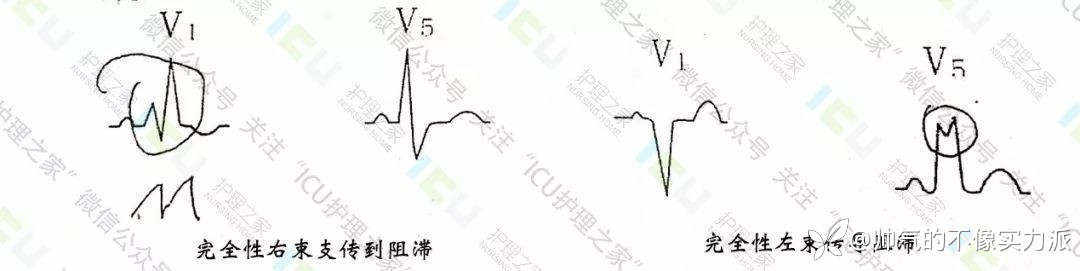 手把手教你看心电图，婴儿式教学