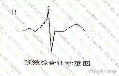手把手教你看心电图，婴儿式教学