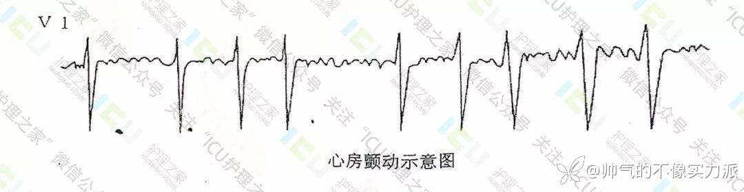 手把手教你看心电图，婴儿式教学