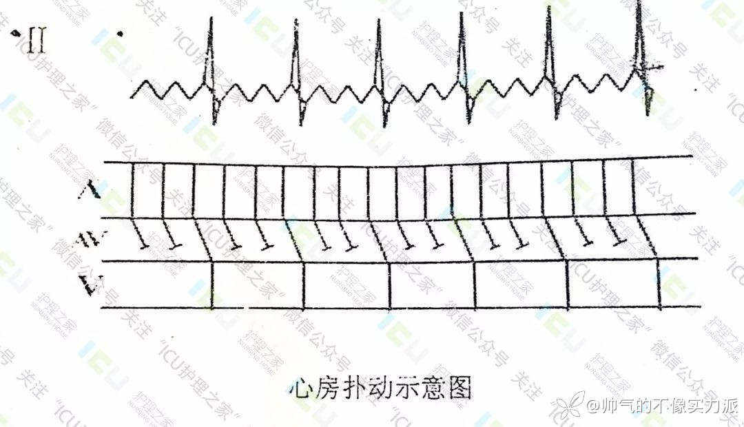 手把手教你看心电图，婴儿式教学