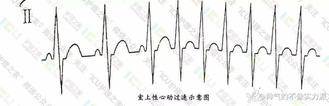 手把手教你看心电图，婴儿式教学