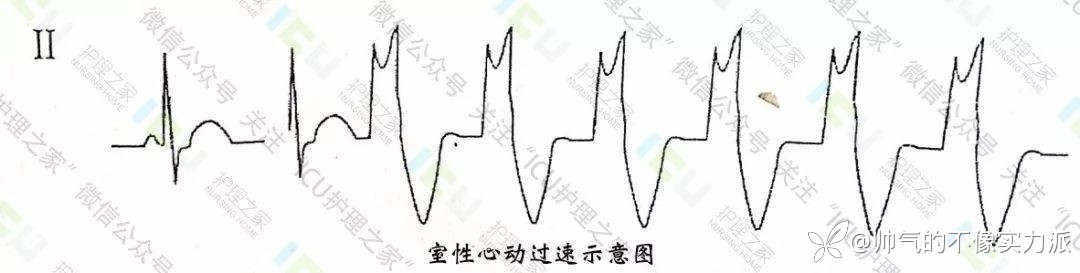手把手教你看心电图，婴儿式教学