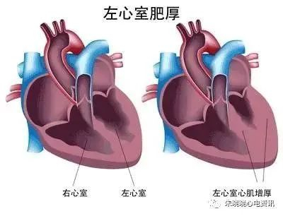 全面解读心电图报告，不再懵懵懂懂！