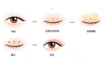 三点定位双眼皮价格，单眼皮变双真实果