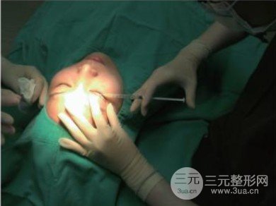 三点定位双眼皮价格，单眼皮变双真实果