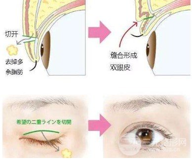 三点定位双眼皮价格，单眼皮变双真实果