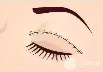 三点定位双眼皮价格，单眼皮变双真实果