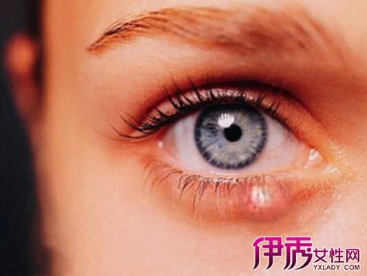 【图】怎样快速消除哭后眼肿   7个小妙招快速消肿