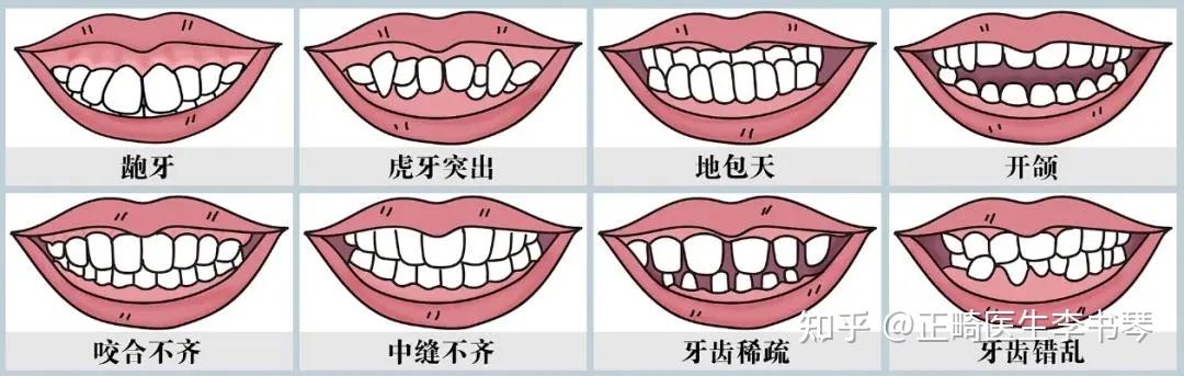 纯干货｜牙齿矫正 一篇给你说清楚！！