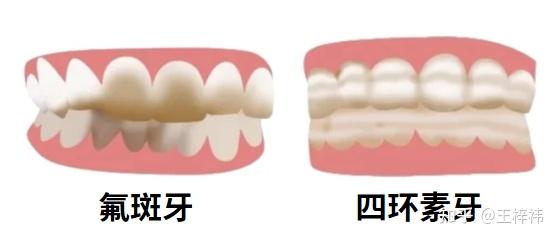 为什么长期刷牙，牙齿还是很黄？牙齿变黄的原因有哪些？