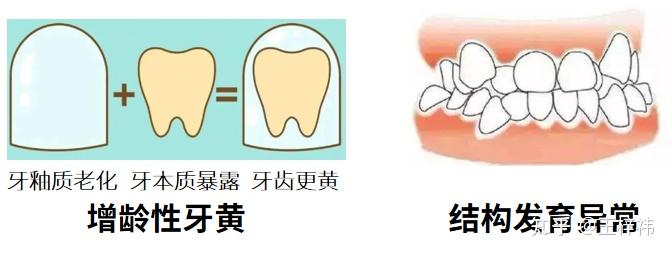 为什么长期刷牙，牙齿还是很黄？牙齿变黄的原因有哪些？