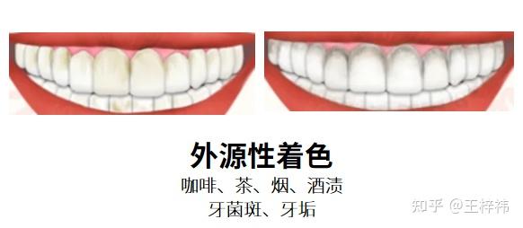 为什么长期刷牙，牙齿还是很黄？牙齿变黄的原因有哪些？