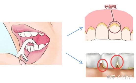 为什么长期刷牙，牙齿还是很黄？牙齿变黄的原因有哪些？