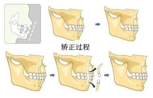 从牙齿错乱到整齐大白牙，整牙只看这一篇就够了！牙齿矫正：牙套、价格、正畸方案、后期护理都齐了！