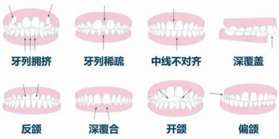 从牙齿错乱到整齐大白牙，整牙只看这一篇就够了！牙齿矫正：牙套、价格、正畸方案、后期护理都齐了！